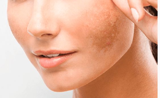 ¿Qué es el “paño” o melasma y cómo tratarlo?