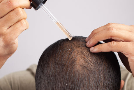 ¿Es seguro el Minoxidil?