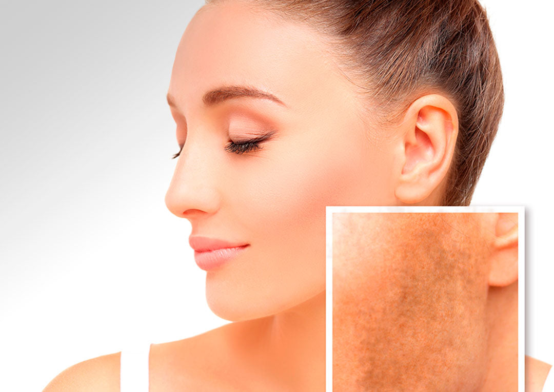 mujer tratamiento melasma, paño, manchas